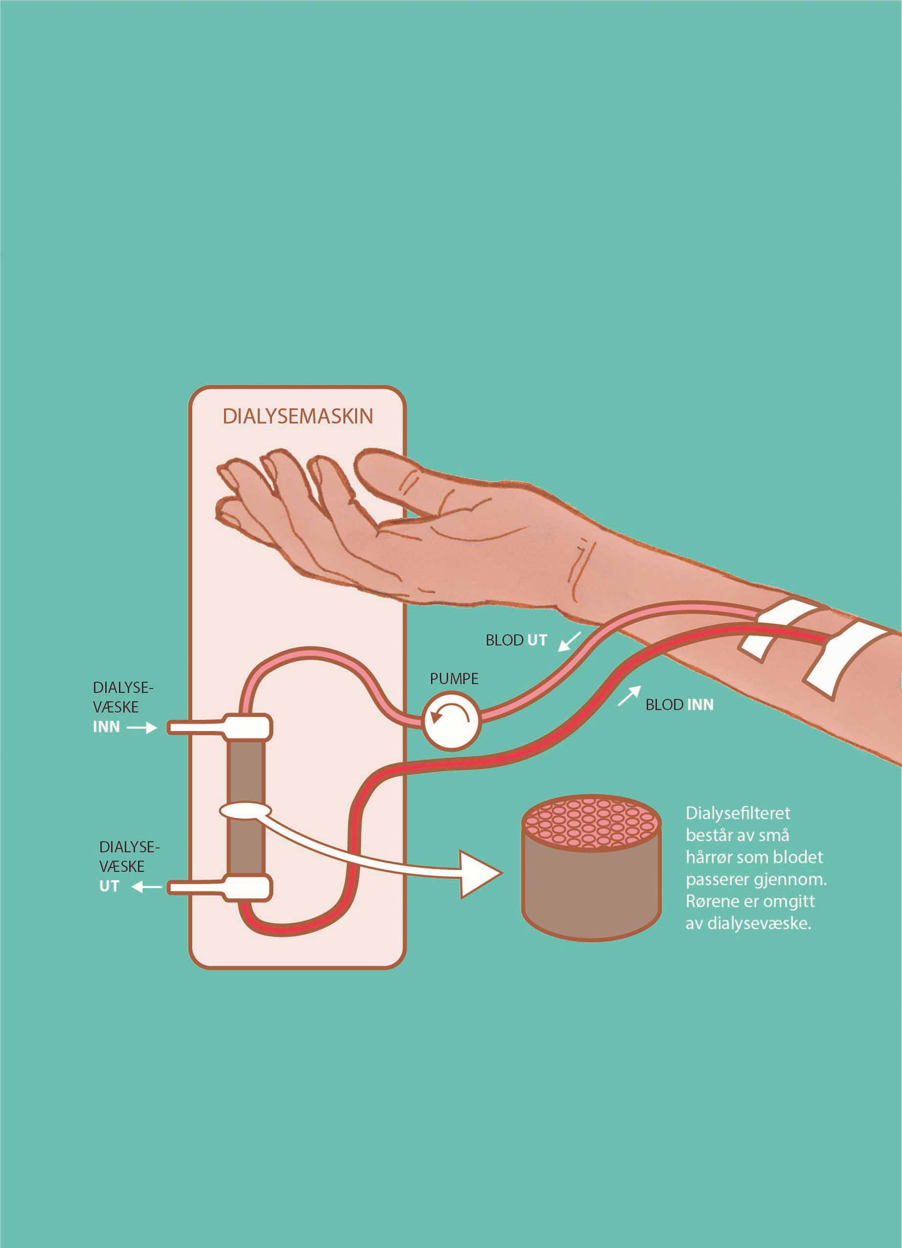 Bildet viser hvordan hemodialyse fungerer. 